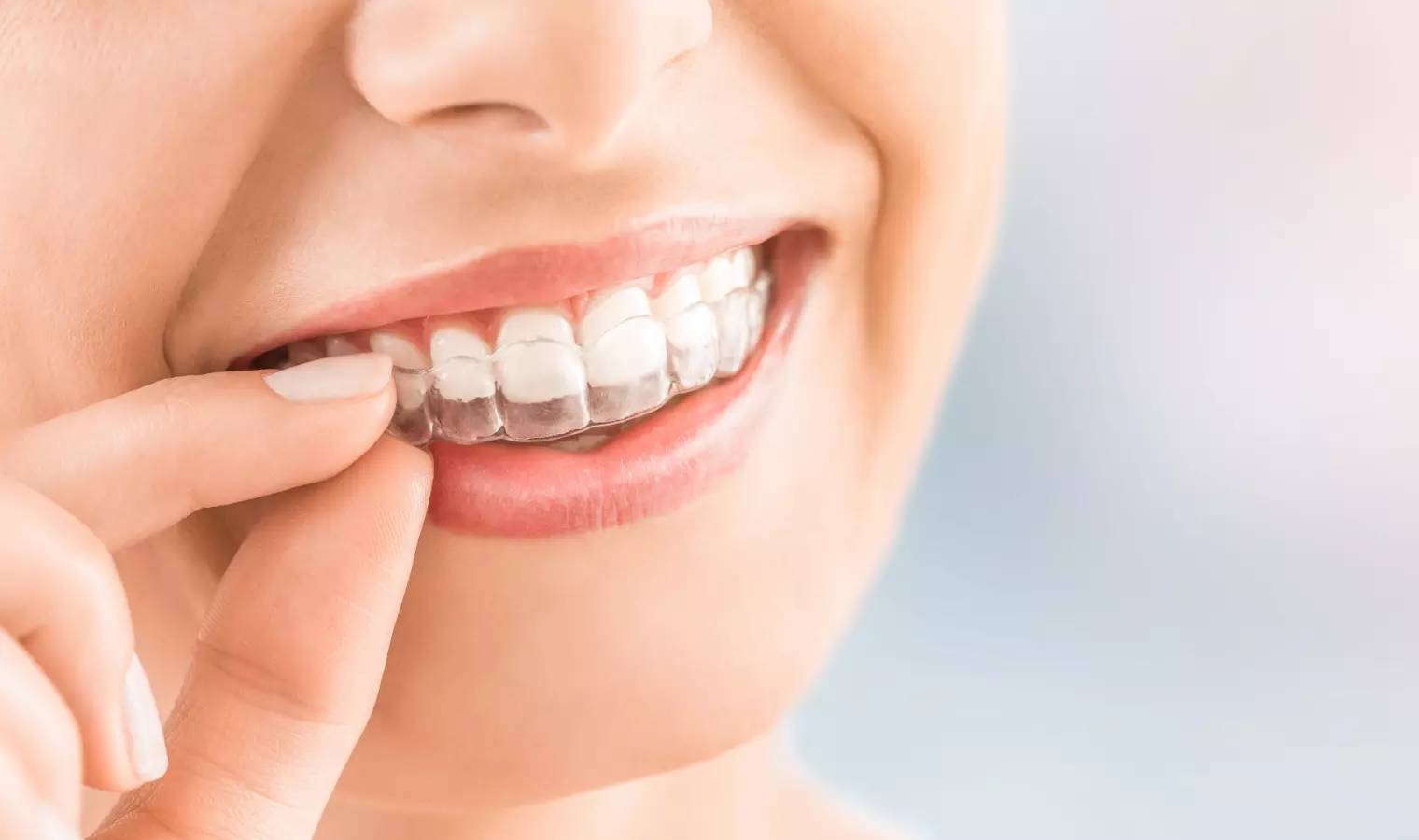 ホームホワイトニング