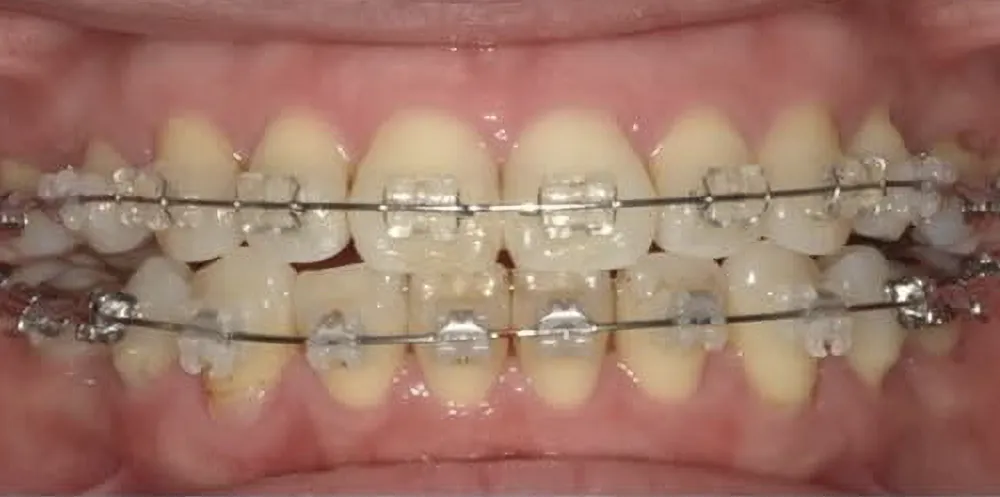 メタルワイヤー